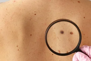 Schwarzem Hautkrebs vorbeugen: 10 einfache Tipps mit grosser Wirkung